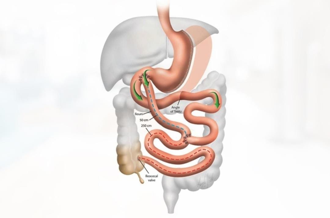Bipartición Duodenal